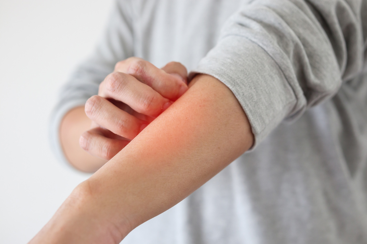 dermatite atópica feridas em regiões de dobras entre as pregas da pele