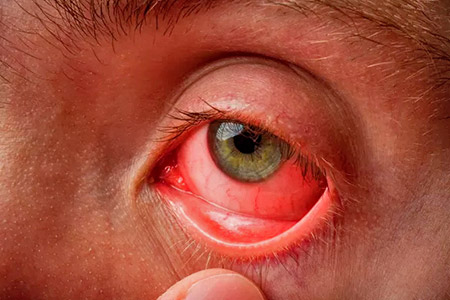 O Projeto Brasil sem Alergia oferece gratuitamente, em todas as suas unidades no Rio de Janeiro, tratamentos para conjuntivite alérgica