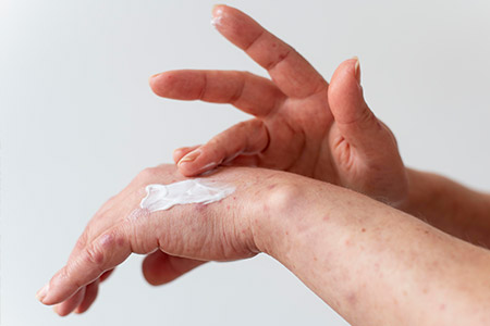 O Projeto Brasil sem Alergia oferece gratuitamente, em todas as suas unidades no Rio de Janeiro, testes e vacinas para tratamento de dermatite atópica (eczema)