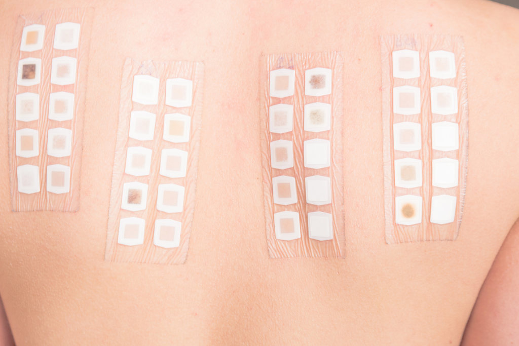 teste de contato patch test alergia