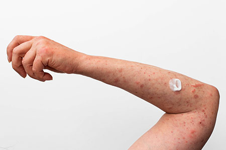 O Projeto Brasil sem Alergia realiza testes de alergia podem ajudar a detectar alergias a alimentos que você come como camarão, amendoim, leite, chocolate, carne de porco