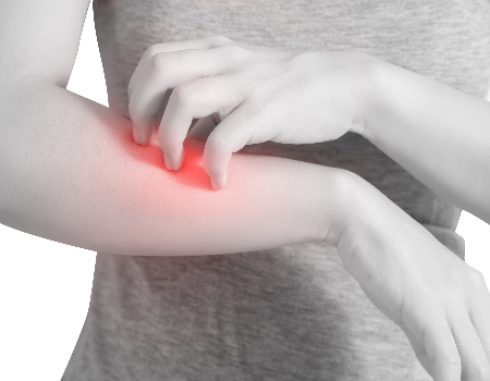 tratamento para urticária no Brasil Sem Alergia 